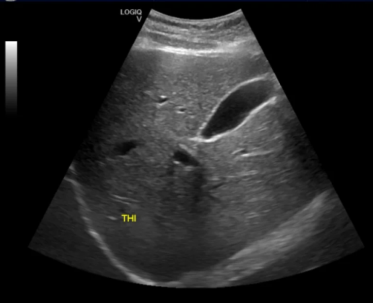 Perbandingan citra USG B-Mode konvensional dan Tissue Harmonic Imaging pada pemeriksaan kantung empedu