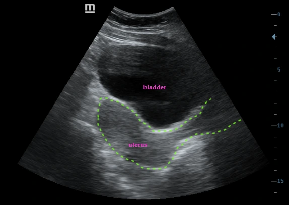 Ilustrasi pemeriksaan USG transabdominal untuk mengevaluasi pengaruh volume bladder terhadap visualisasi uterus