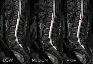 Inovasi AIR™ Recon Deep Learning untuk Mengoptimalkan Kualitas Citra MRI Lumbal