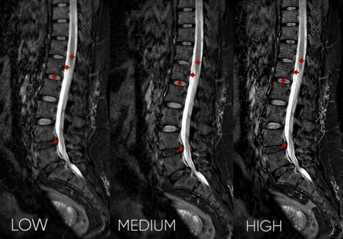 Inovasi AIR™ Recon Deep Learning untuk Mengoptimalkan Kualitas Citra MRI Lumbal