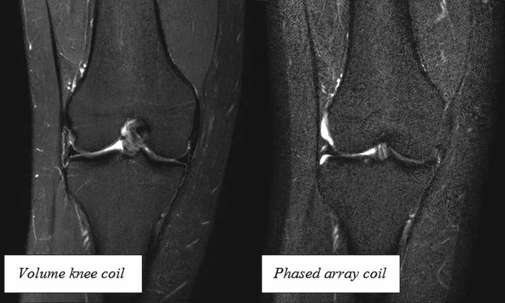 Perbandingan kualitas citra MRI lutut menggunakan volume knee coil dan phased array torso coil