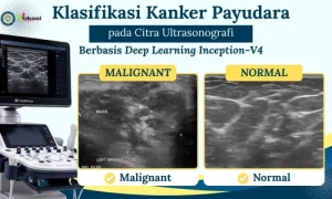 Klasifikasi Kanker Payudara pada Citra Ultrasonografi Berbasis Deep Learning Inception-V4